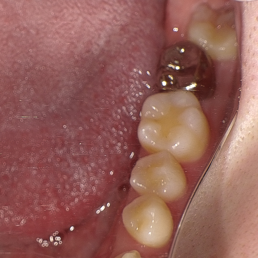 精密根管治療にて抜歯宣告された歯を救った症例　2治療方法01
